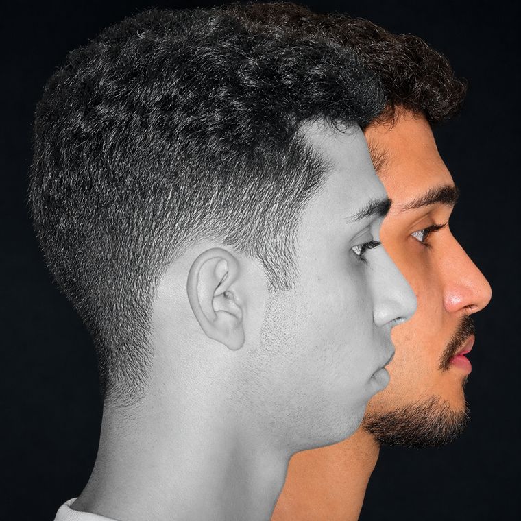 Cirurgia ortognática, caso 1, antes e depois